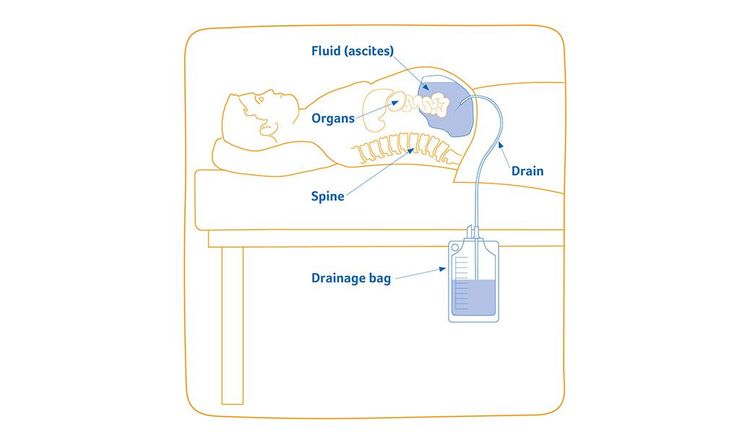 Image shows a drawing of person lying down on a bed while fluid is drained from the body. The fluid comes out of the body through a drainage tube and goes into a drainage bag. Spine, organs, fluid (ascites), drain and drainage bag are labelled.