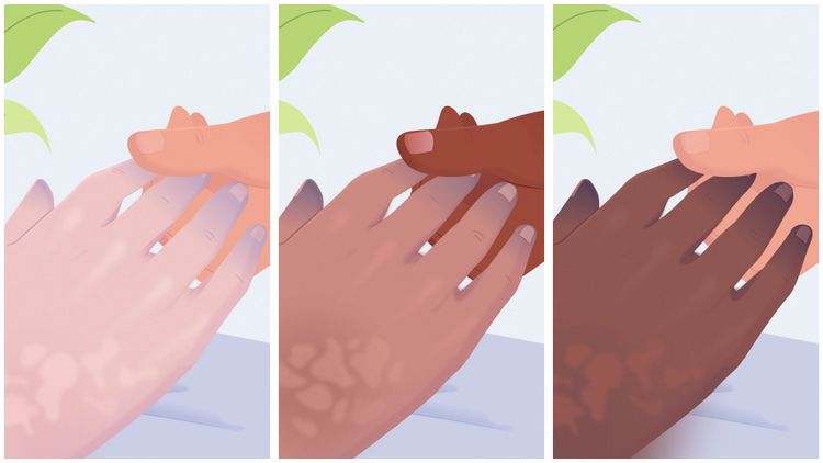 Fingers turning blue or grey on three skin tones