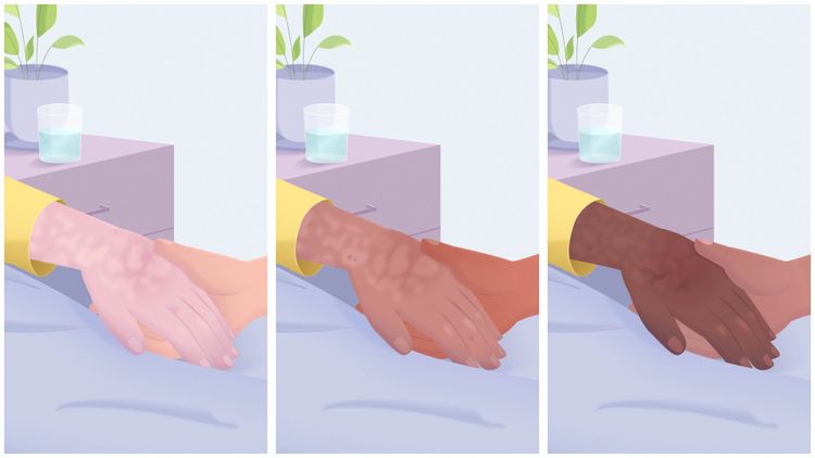 Mottling on different skin tones