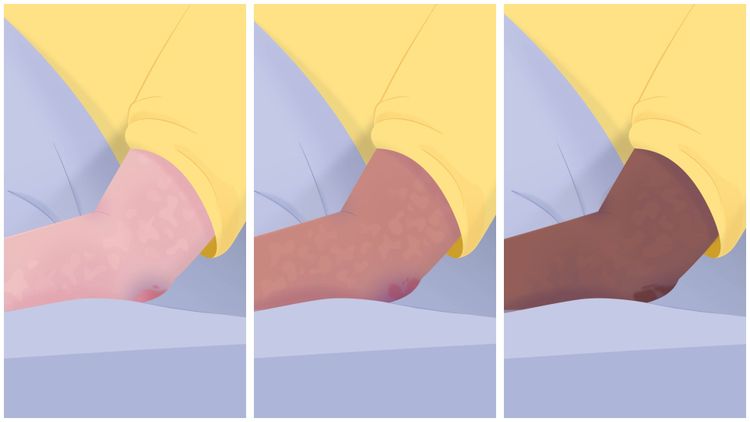 Pressure sores on three skin tones